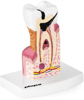 Maquette anatomique de la dentition humaine - Molaire malade