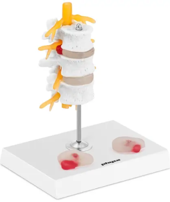 Maquette anatomique des disques intervertébraux - Hernie discale lombaire - En couleurs